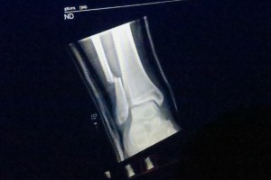 Fractured view: X-ray of Dave Grohl's fibula show from the stage (un-attributed photo)